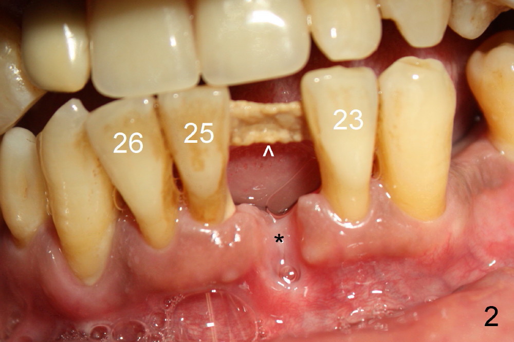 Immediate Implantsupported Bridge, Duluth, GA Dentist Dental Education